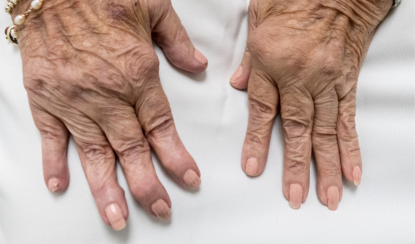 Treatment Options for Arthritis